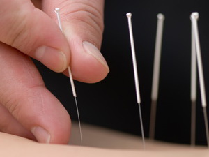 acupuncture