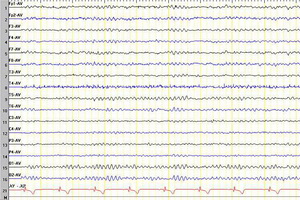 HEG: hemoencephalography