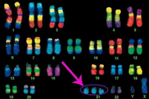 Trisomy 21